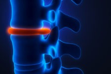 Esguince Lumbar