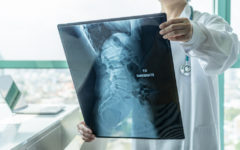 fracturas espinal